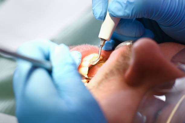 Best Emergency Dental Care for Broken or Chipped Teeth in Long Beach, NY