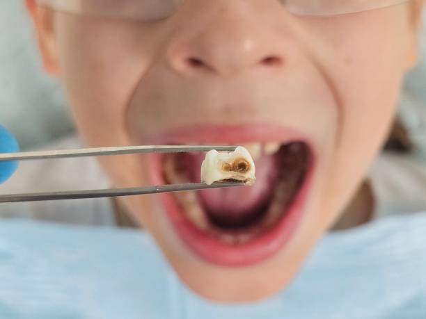 Best Emergency Treatment for Dental Infections or Abscesses in Long Beach, NY